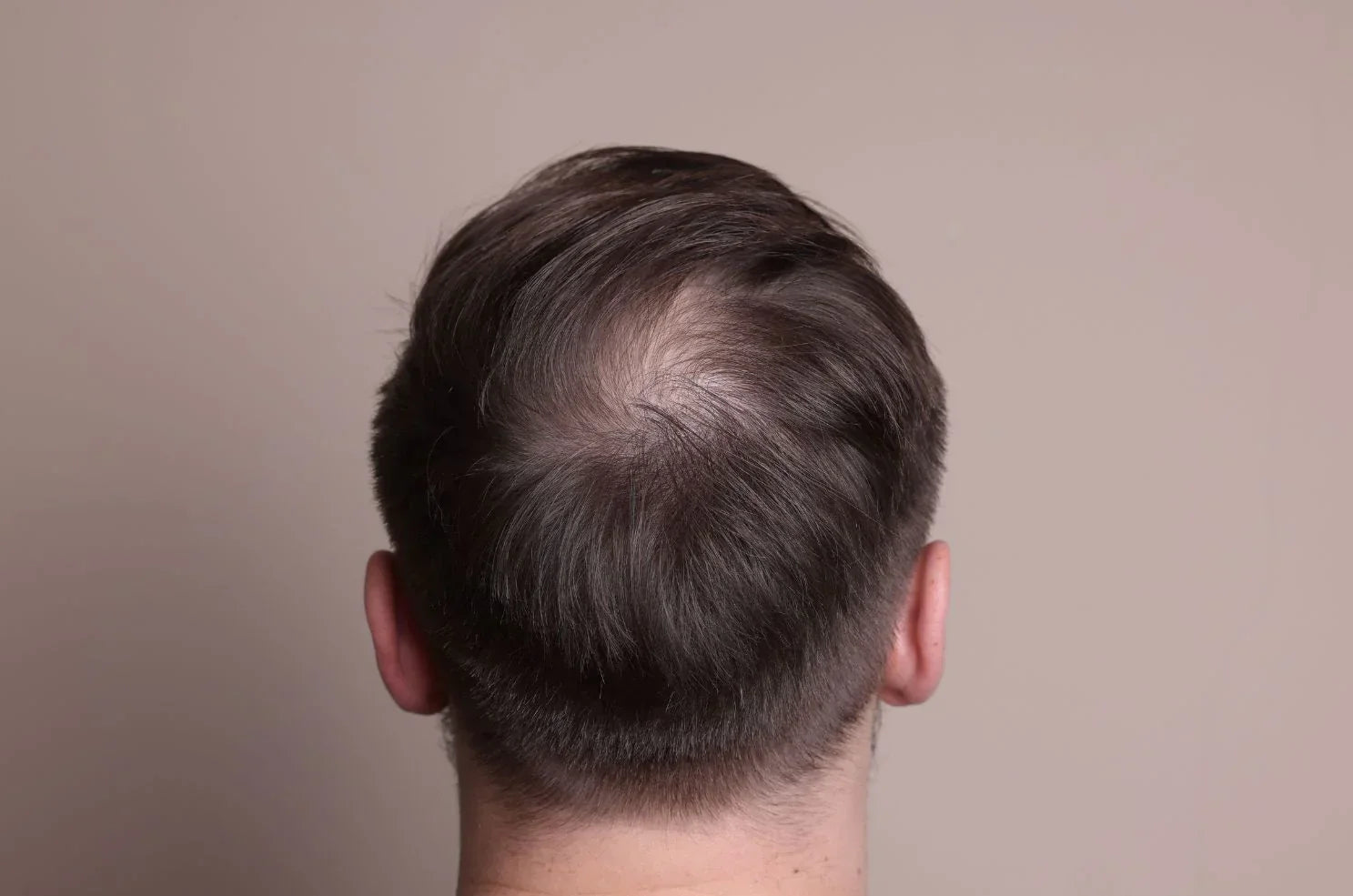 Losing Hair in Your 20s? Here’s Why It Happens Sooner Than You Think