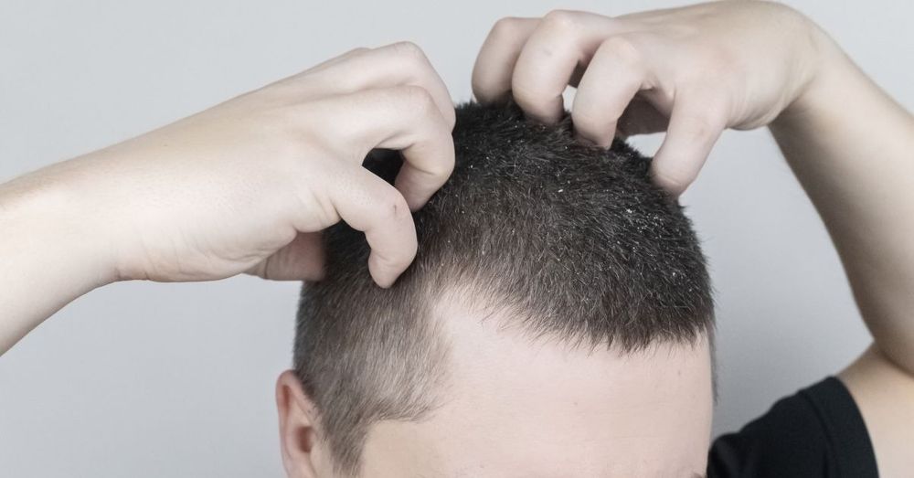 Get Rid of Itchy Scalp and Dandruff Fast