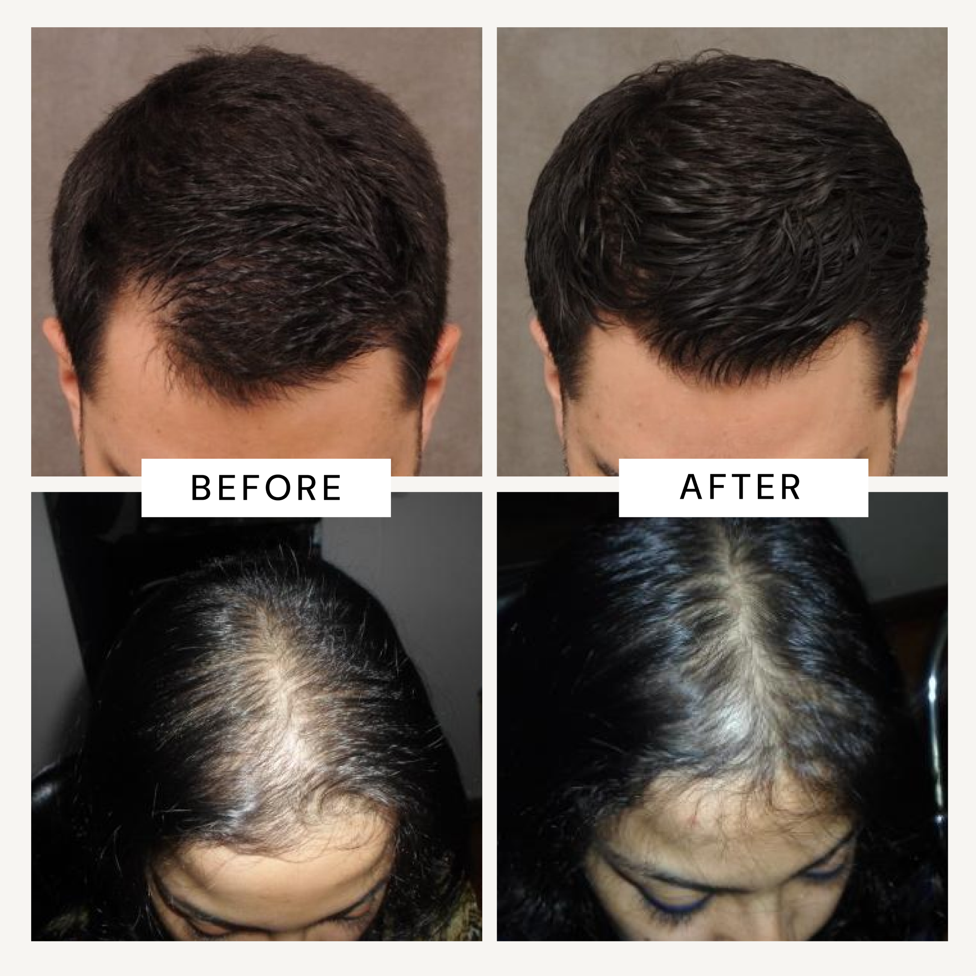 ANAGROW SERUM + SAW PALMETTO SHAMPOO