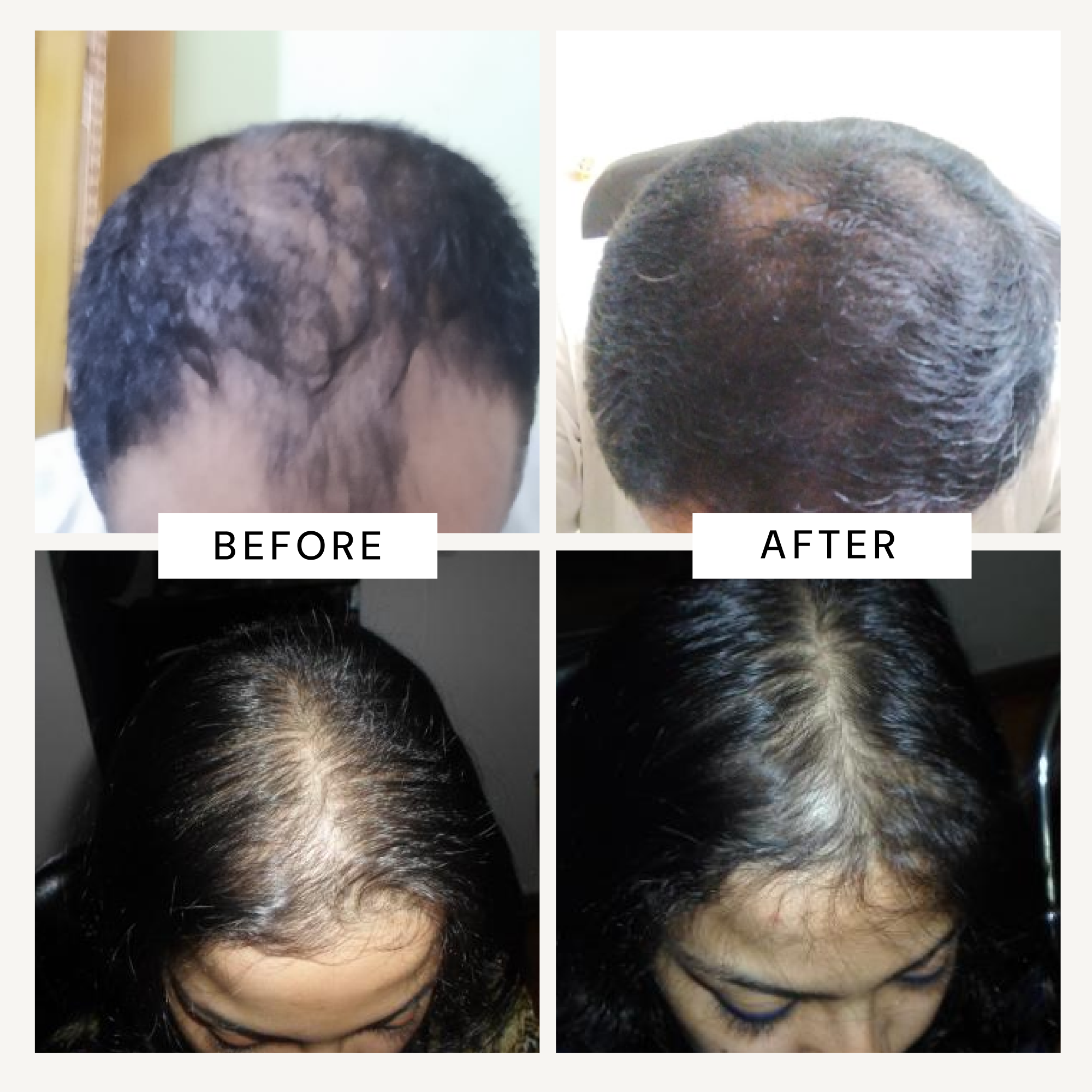 RICHFEEL Scalp Cleanser with Saw Palmetto | Premium Anti-Hair Fall & DHT Blocker Shampoo  (Pack of 2)