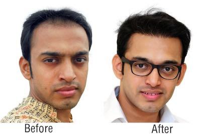 Hair Transplant in Mumbai – Permanent Hair Restoration - RichFeel  Trichology | PressReleasePoint