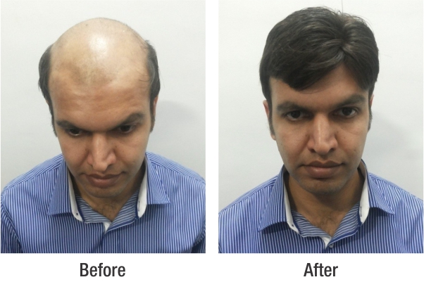 Get The Best Hair Transplant In Lucknow DHI India  Health Beauty   Fitness Service In Lucknow Cantonment Lucknow  Clickin