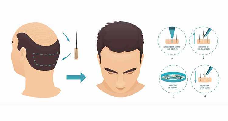 Best FUE Hair Transplant In India | Follicular Unit Extraction Best FUE Hair Transplant In India | Follicular Unit Extraction