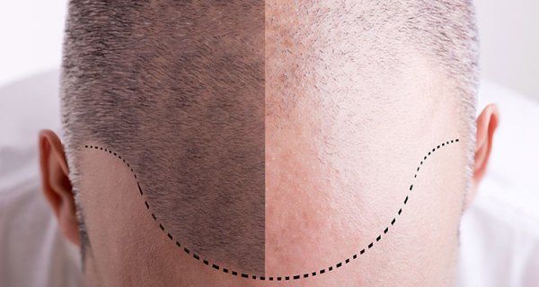 Advantages and Disadvantages of Hair Transplant (Unbiased Review) Advantages and Disadvantages of Hair Transplant (Unbiased Review)