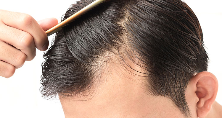 How To Prevent Hair Loss & Thinning Hair - Amazing Tips That Work!