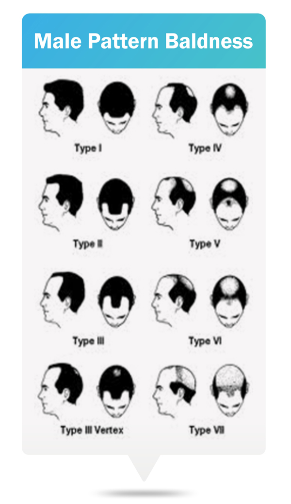 Male Pattern Baldness Symptoms, Causes, Treatment & Prevention RichFeel