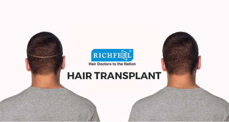 Why choose RichFeel AHI for your Hair Transplant? Why choose RichFeel AHI for your Hair Transplant?