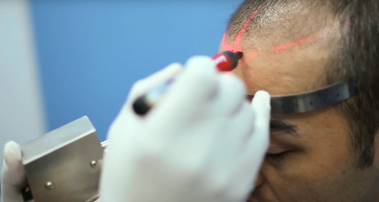 Which is the best method for hair transplant in India? - hair transplant before and after Which is the best method for hair transplant in India? - hair transplant before and after