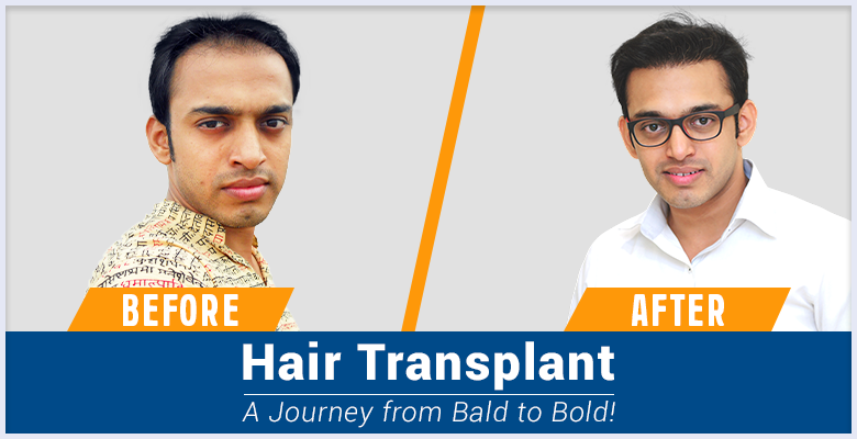 AHI Hair Transplant with the experts at RichFeel|hair&scalp_problems|AHI_technique|male_pattern_baldness