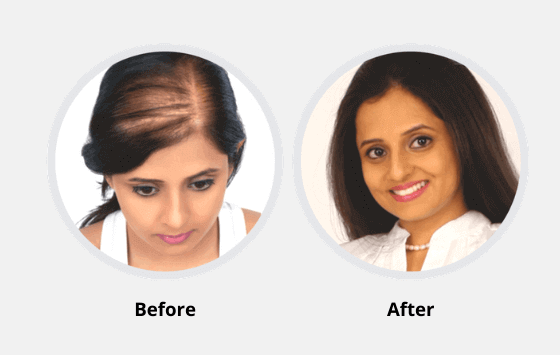 A Patients Journey  RichFeel Hair Transplant