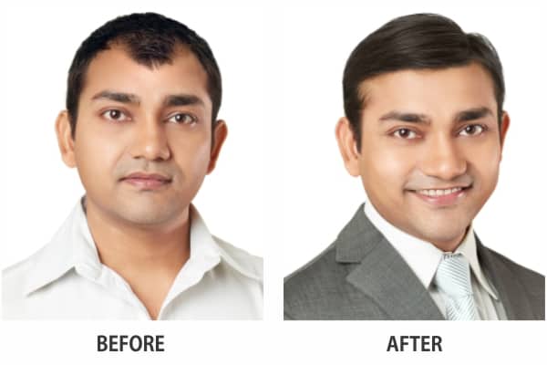 Hair System – Non Surgical Hair Restoration | RichFeel Trichology