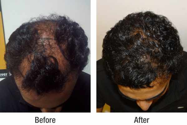 RichFeel Reviews for Hair Transplant at RichFeel's Mumbai Clinic