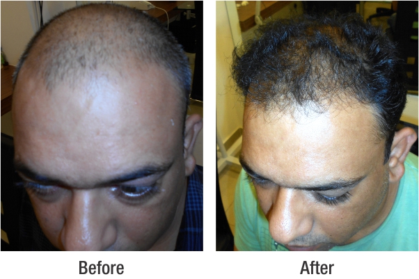 RichFeel Reviews for Hair Treatment at RichFeel's Delhi Clinic