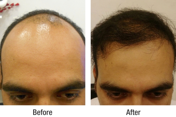 RichFeel Reviews for Hair Treatment at RichFeel's Delhi Clinic