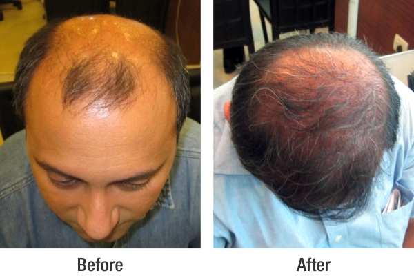 Head Quarters Hair Transplants Reviews