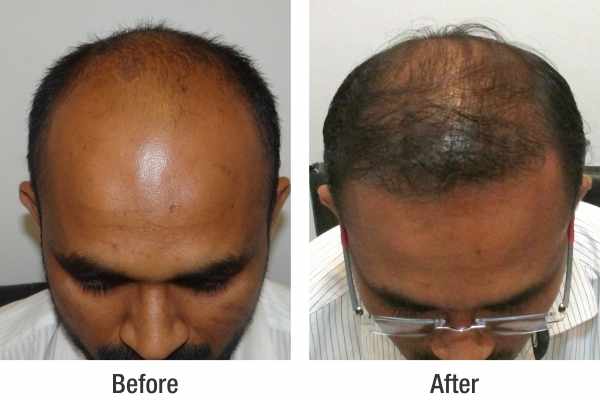 RichFeel Reviews for Hair Transplant at RichFeel's Mumbai Clinic