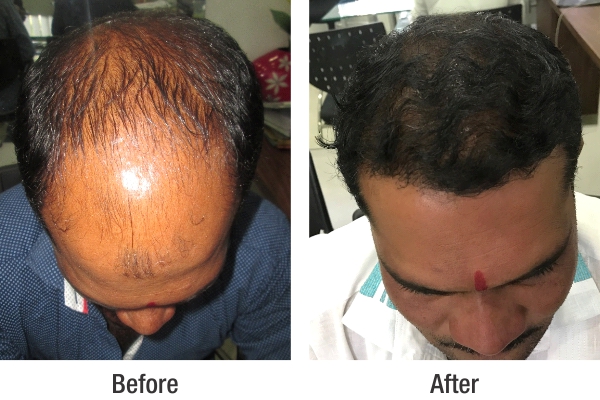 RichFeel Reviews and Customer Experiences for Hair Treatment in Pune