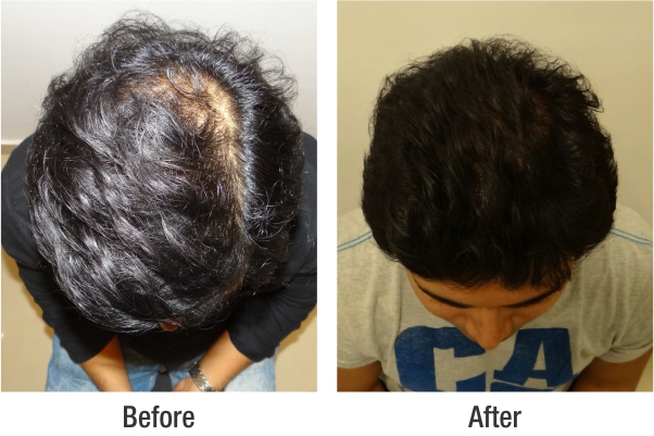 RichFeel's Hair treatment Reviews for Bangalore Clinics
