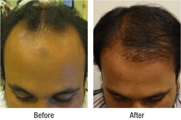 RichFeel's Hair treatment Reviews for Bangalore Clinics