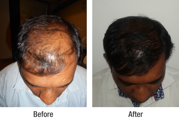 RichFeel Reviews and Customer Experiences for Hair Treatment in Pune