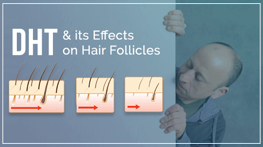 Dihydrotestosterone (DHT), and its role in hair loss | RichFeel