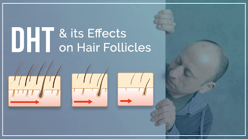 Dihydrotestosterone (DHT), and its role in hair loss | RichFeel Dihydrotestosterone (DHT), and its role in hair loss | RichFeel