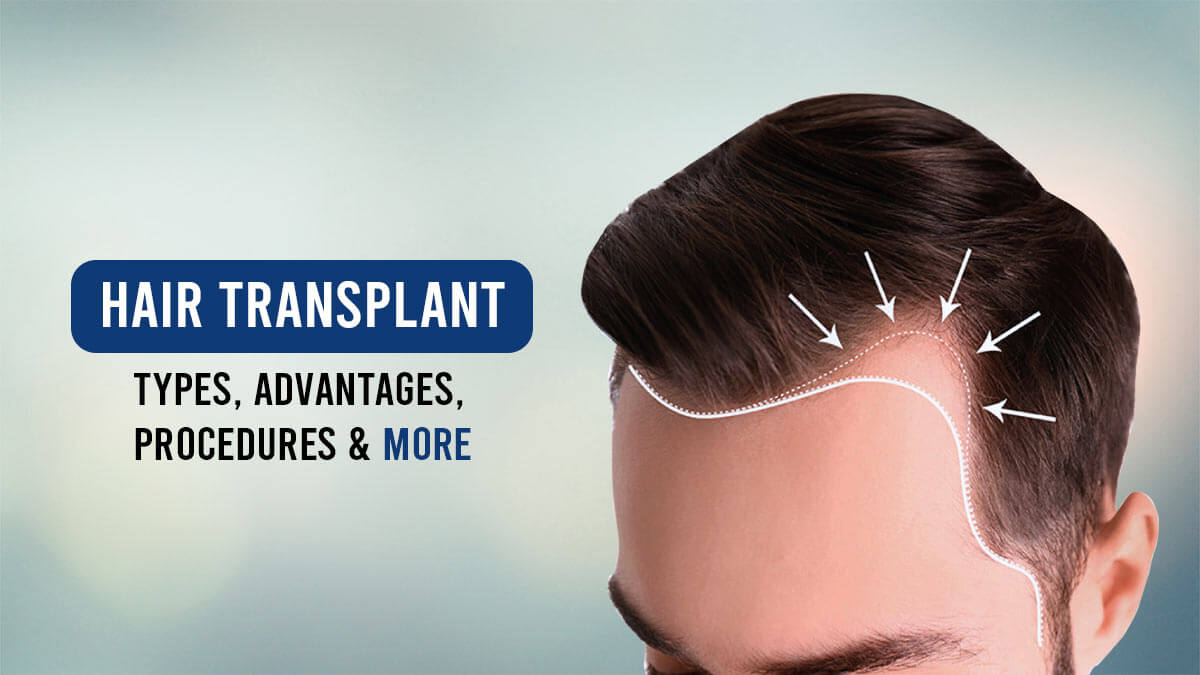 Hair transplant: Types, Advantages, Procedures and More| RichFeel