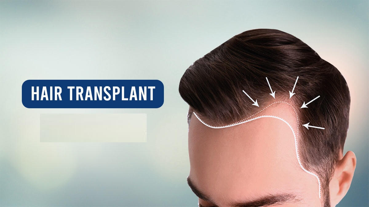 Hair transplant: Types, Advantages, Procedures and More| RichFeel